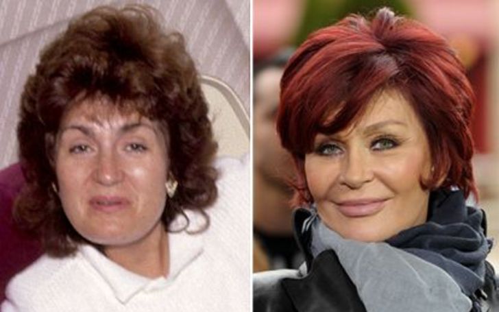 Sharon Osbourne Facelift - The Full Story